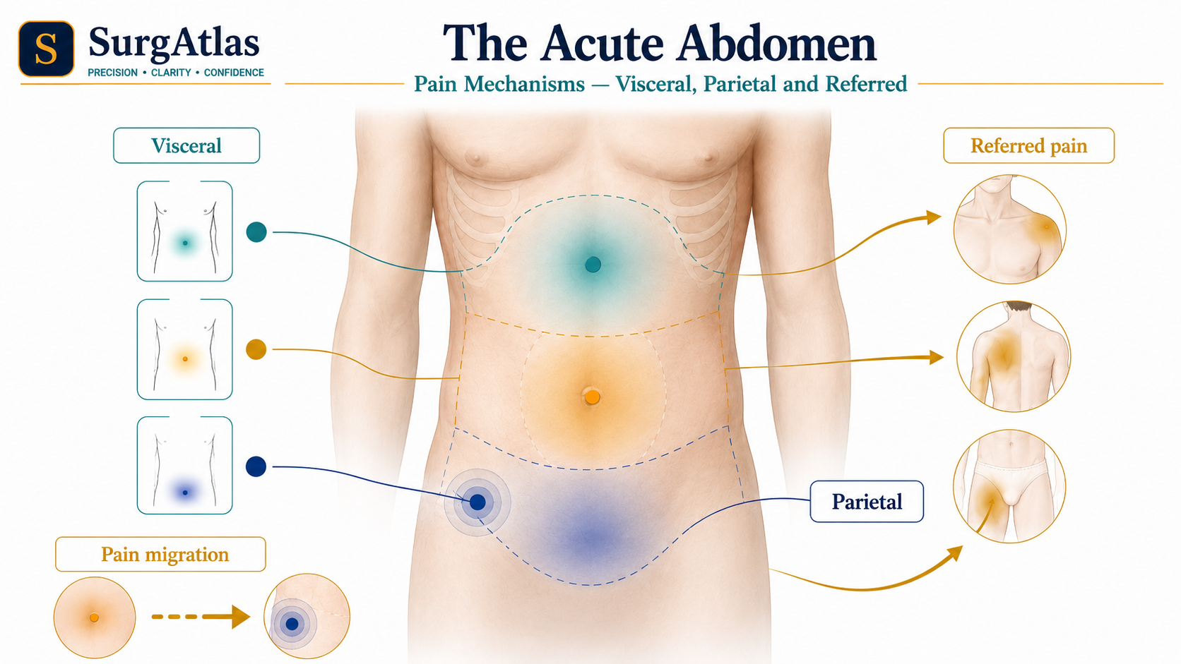 SurgAtlas illustration comparing visceral, parietal and referred abdominal pain, including pain localisation and migration patterns relevant to the acute abdomen.