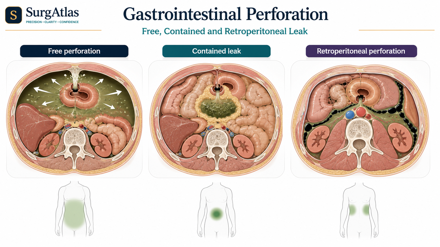 Gastrointestinal Perforation Patterns SurgAtlas illustration comparing free, contained and retroperitoneal gastrointestinal perforation and the different patterns of contamination they produce.