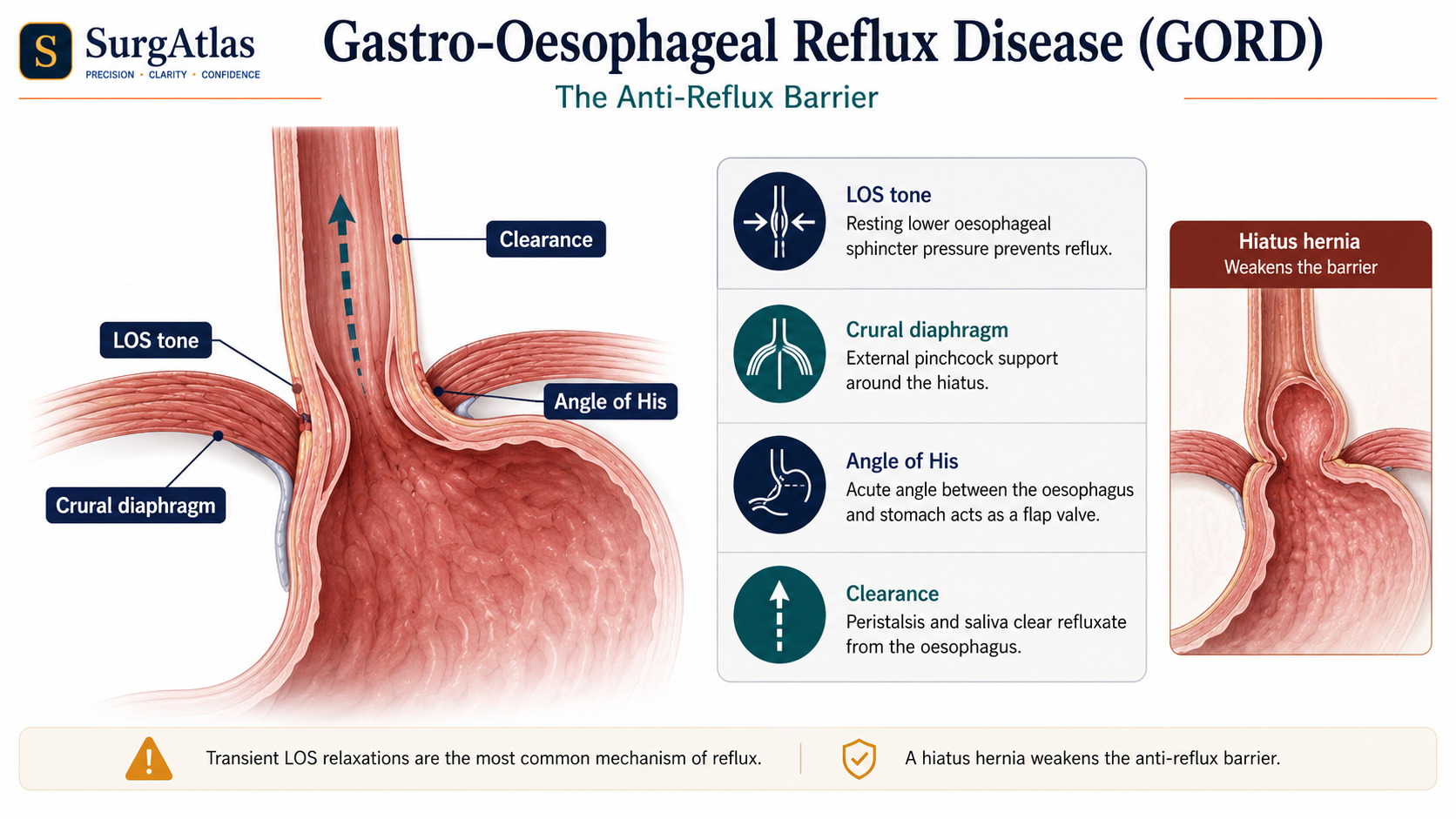 Gastro-Oesophageal Anti-Reflux Barrier SurgAtlas illustration of the gastro-oesophageal anti-reflux barrier showing lower oesophageal sphincter function, the crural diaphragm and gastro-oesophageal junction geometry.